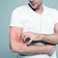 From Itching to Healing: How Acupuncture Transforms Chronic Hives Care